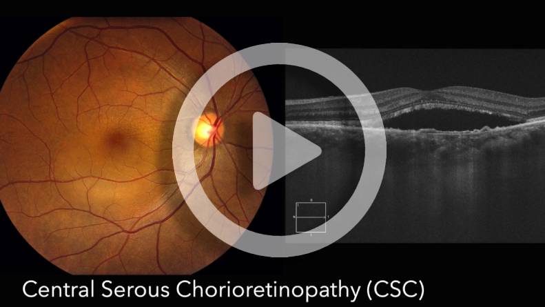Central Serous Chorioretinopathy (CSC)